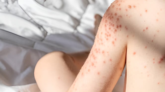 Australian Nationals Contract Measles After Visiting Indonesia, Health Ministry Responds