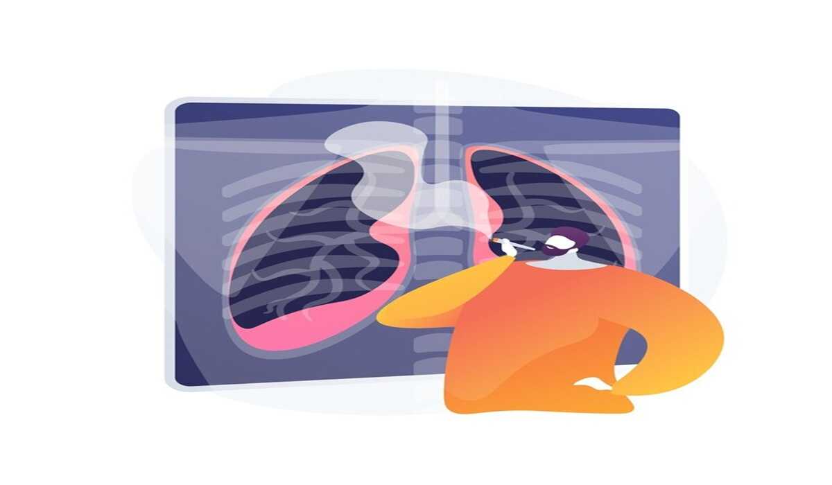 AI Assists in Early Detection of Lung Cancer