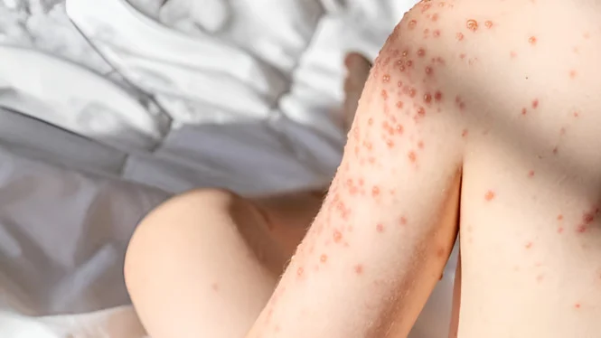 Two Foreign Nationals Test Positive for Measles After Travelling from Indonesia; Ministry of Health Strengthens Early Detection and Measles Immunisation Coverage