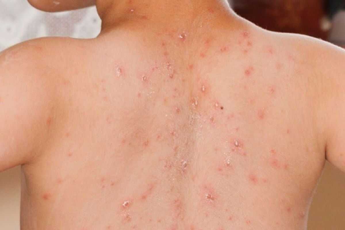 IDAI warns that measles is not a mild illness and carries risk of serious complications
