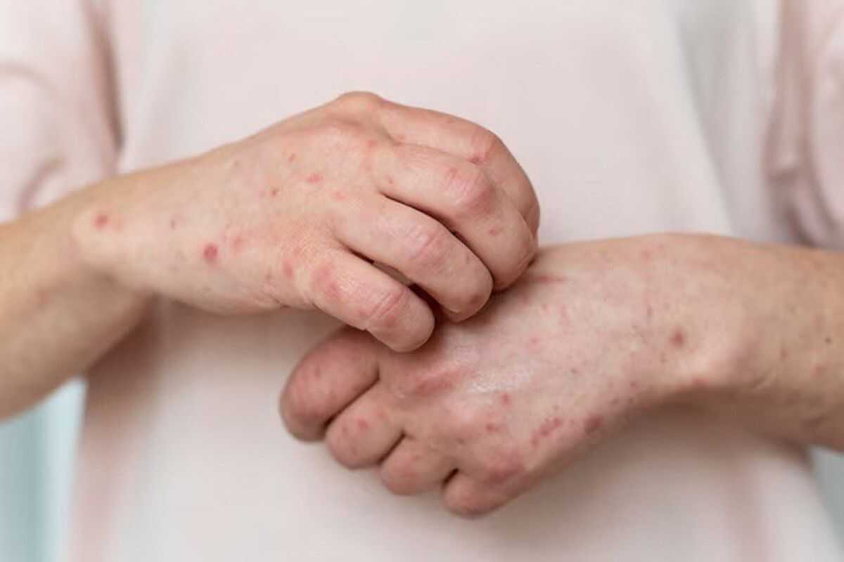 Three stages of measles symptoms to be vigilant about