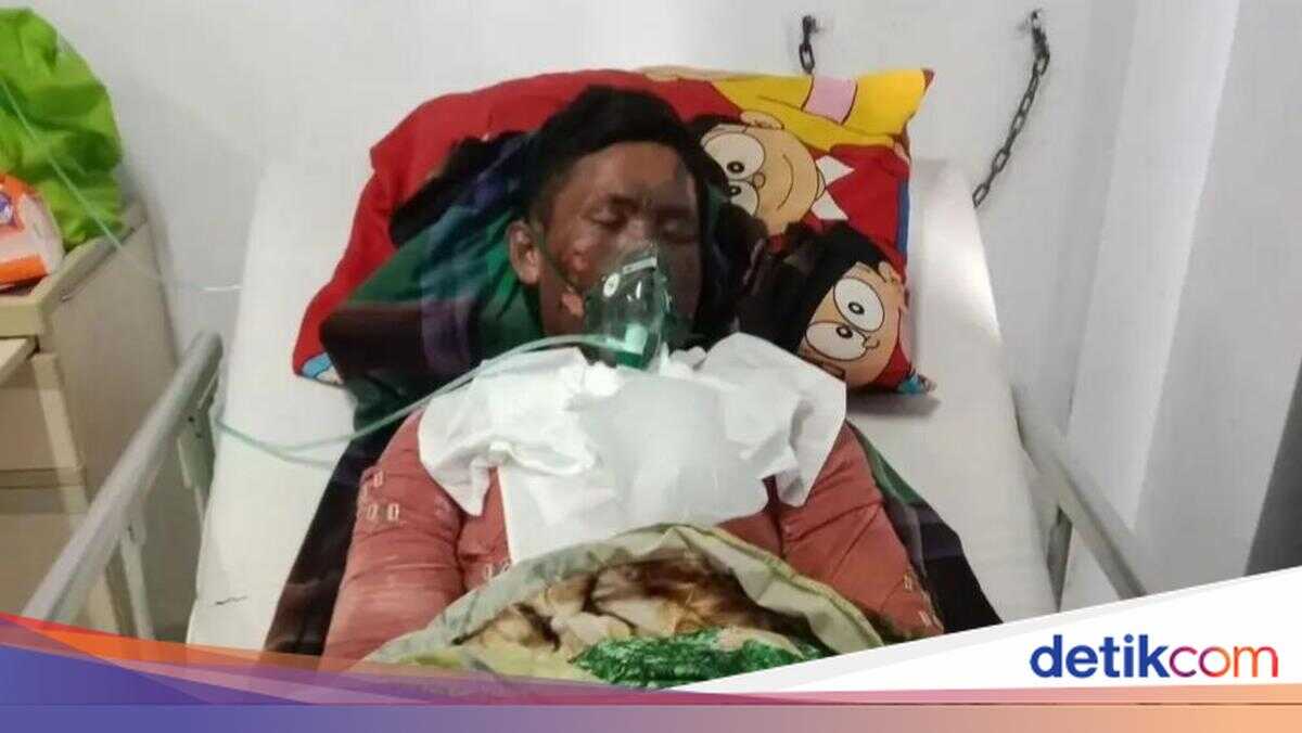 Son Burned by Mother in Sumbawa Dies from Injuries