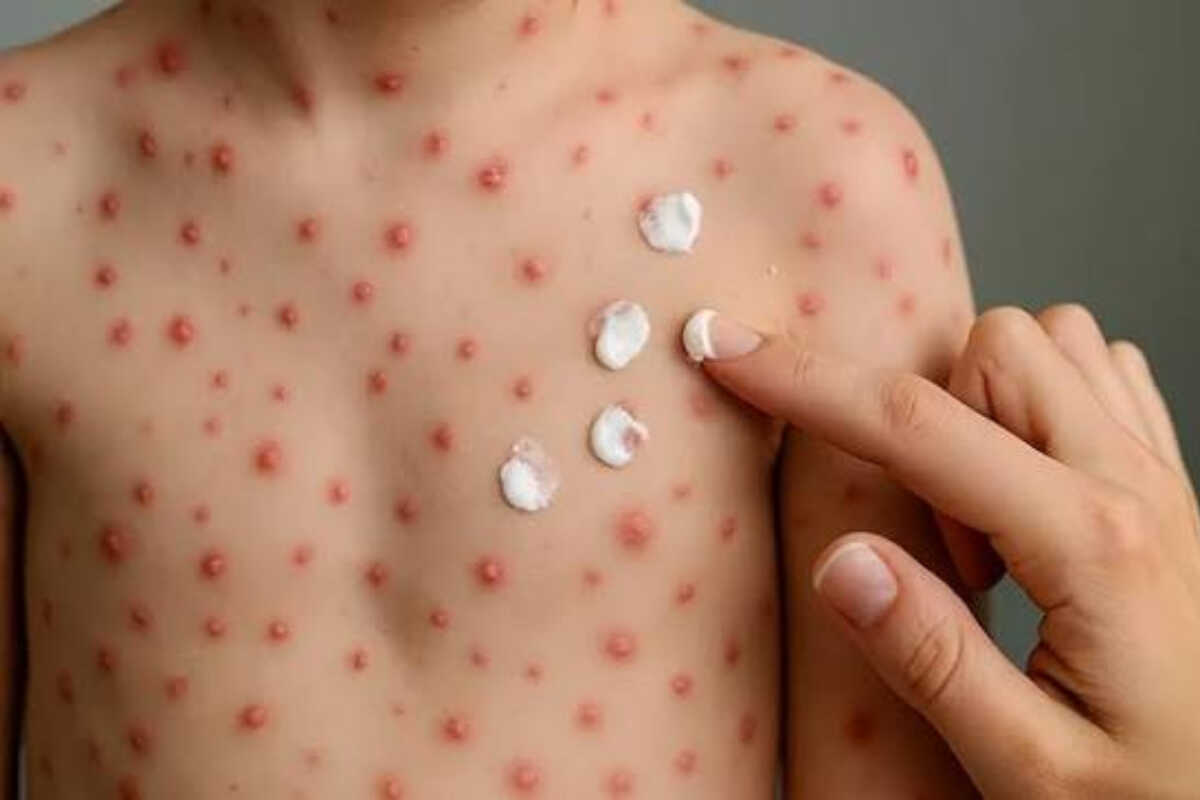 Does Measles Really Make Children Light Sensitive? Here's the Research
