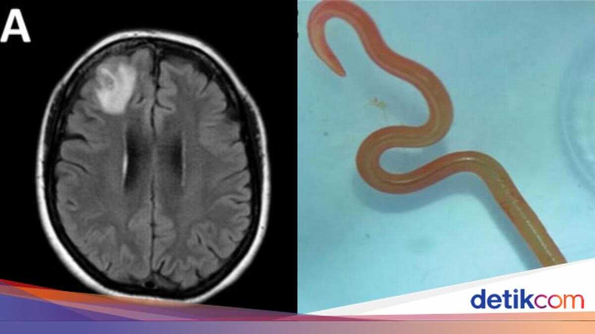 Alarming Discovery: Doctors Find 8 cm Python Parasite in Human Brain