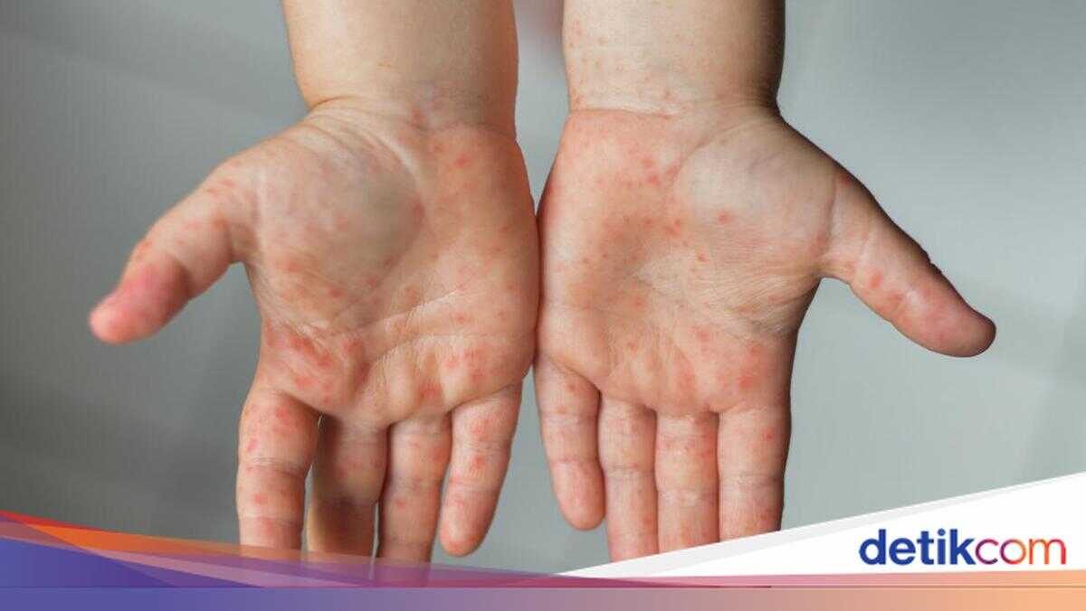 Measles Outbreak Expands in Bima City, 336 Suspected Cases Detected