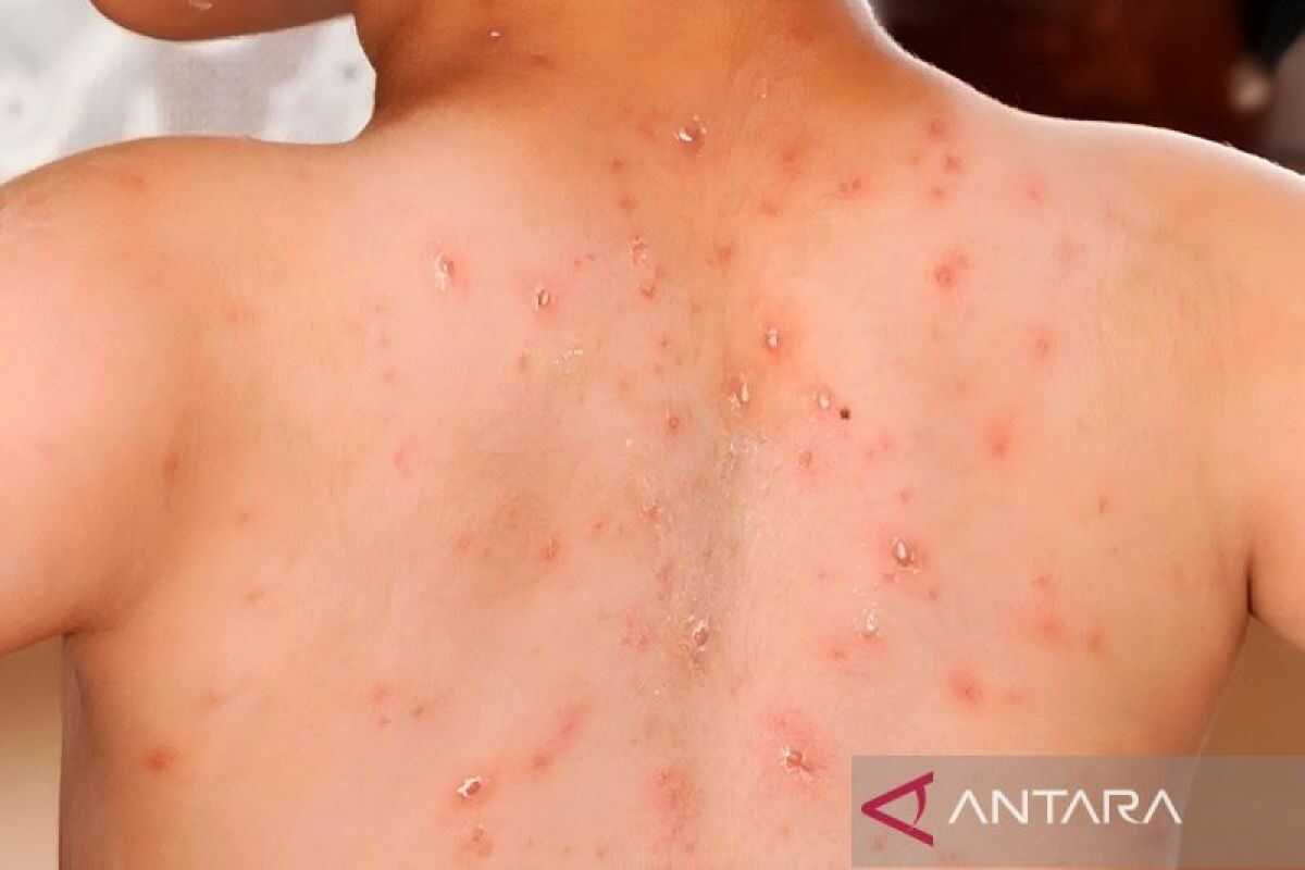 Health Ministry Responds to Influencer's Measles Behaviour, But Goes Out in Public