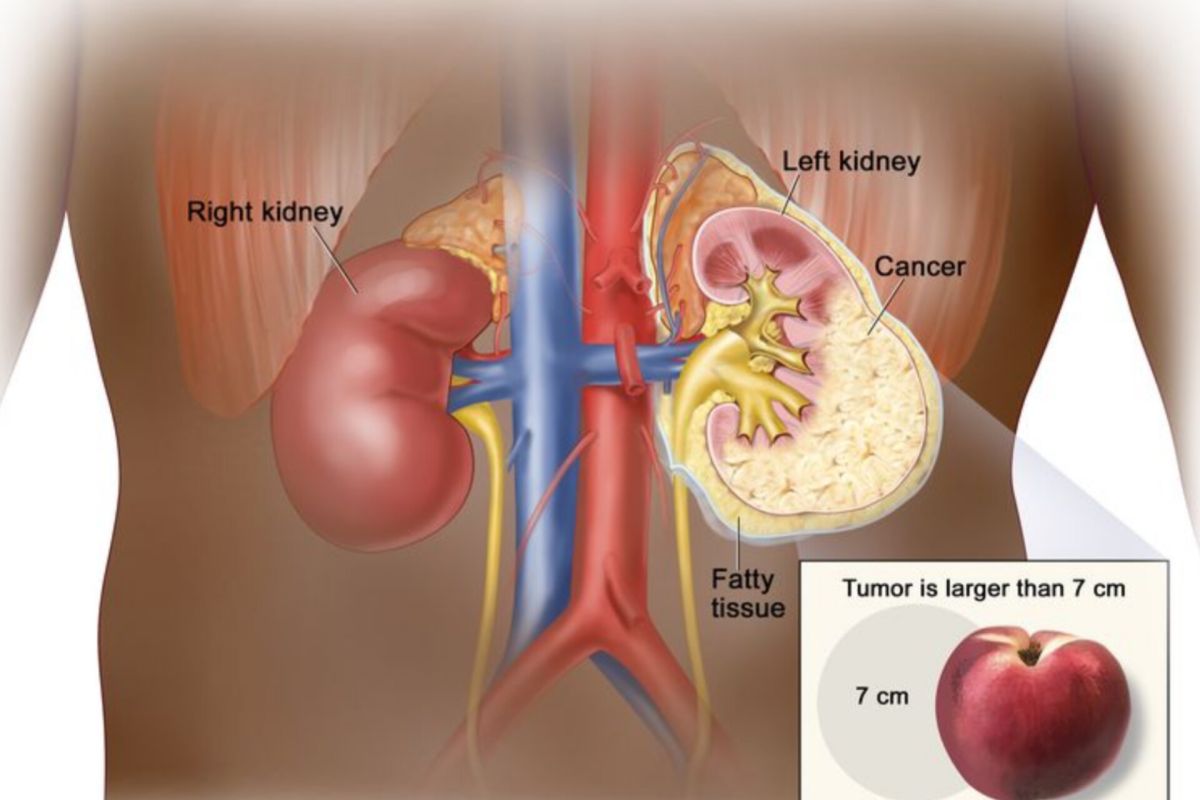 Know the risk factors for kidney cancer, the cancer that afflicted Vidi Aldiano