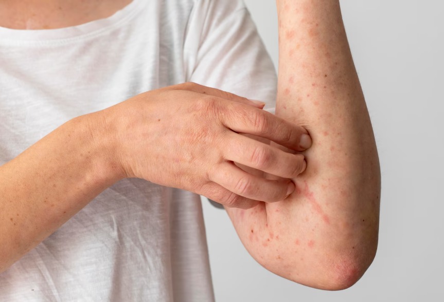 Why Parents Refuse the Measles Vaccine for Their Children? An Analysis of Causes and Solutions