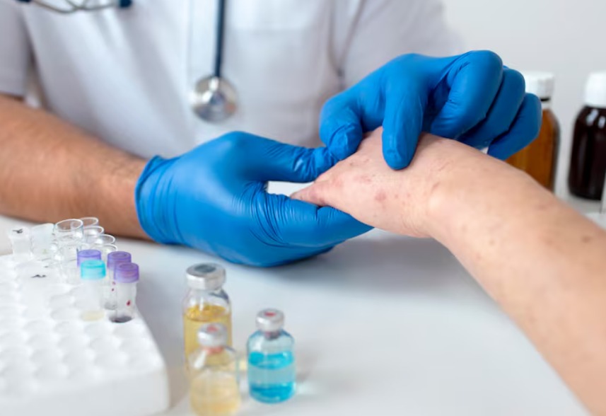 Not Just a Rash: Why the Measles Vaccine Is a 'Lifesaver' in 2026