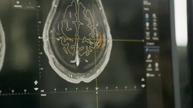 China Aggressively Pursuing Brain-Computer Interface Technology, Expected to Explode Soon