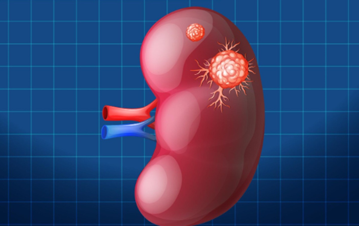 Researchers Warn Kidney Cancer Cases Could Double Within 25 Years