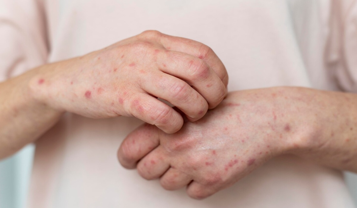 Beware Measles Transmission, Jakarta Health Office Tightens Surveillance at Health Facilities