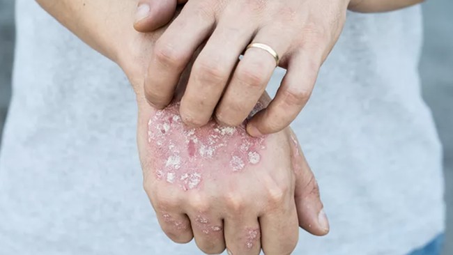 Indonesia Ranks Third Globally for Leprosy, with 16,000 Cases