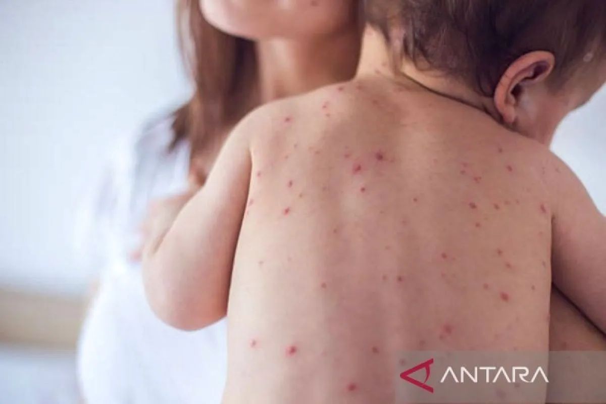 When Measles Threatens Young Children