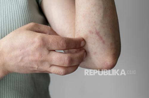 Measles Cases Rise in West Java; Health Department Urges Public Vigilance During Lebaran Travel