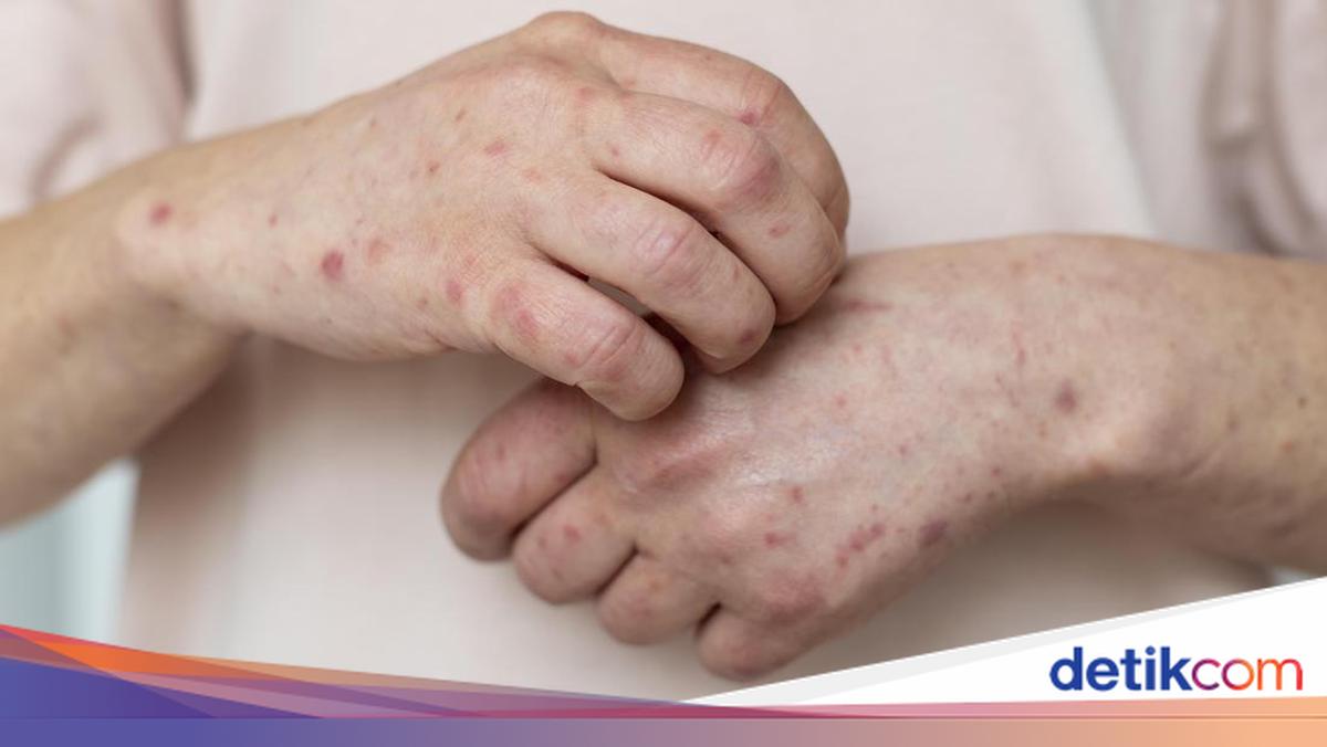 Measles Cases in West Java Surge, Residents Urged to Exercise Caution During Idul Fitri Travel