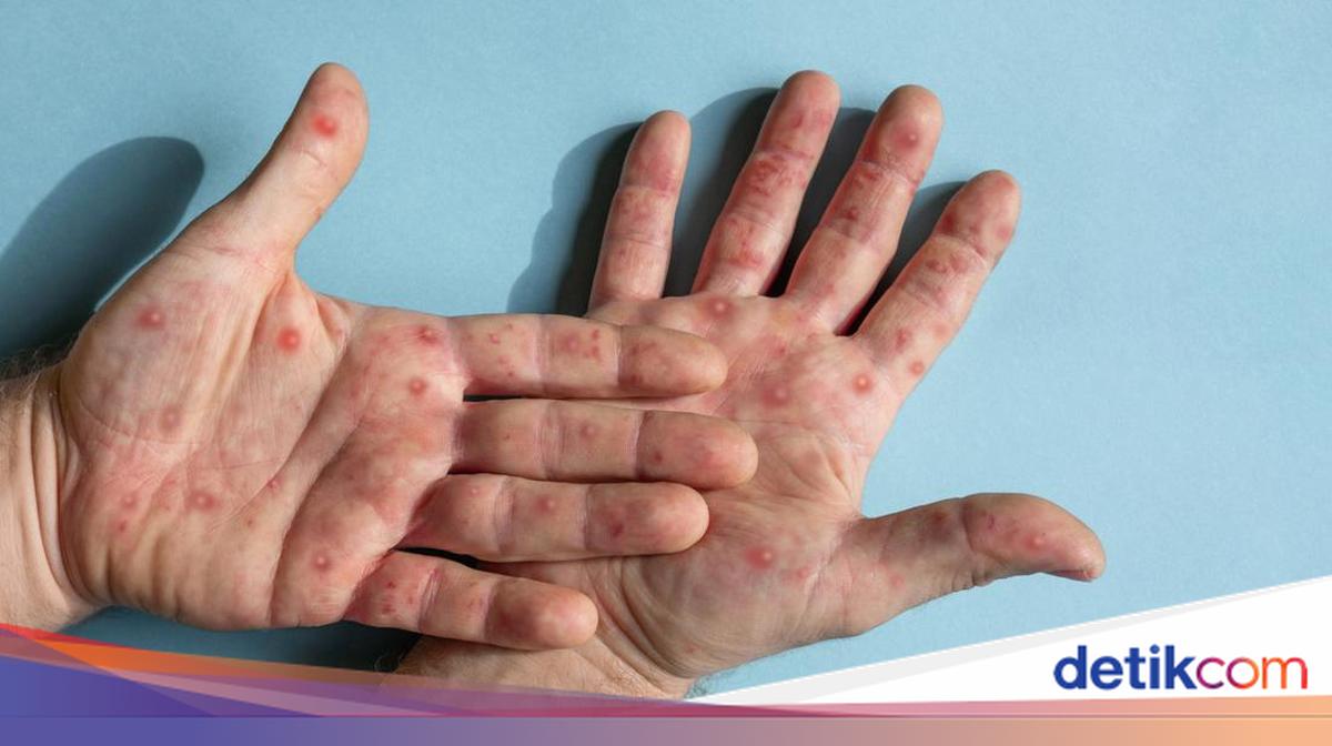 Measles Outbreak Spreads in Dompu, Many Children Born During Pandemic
