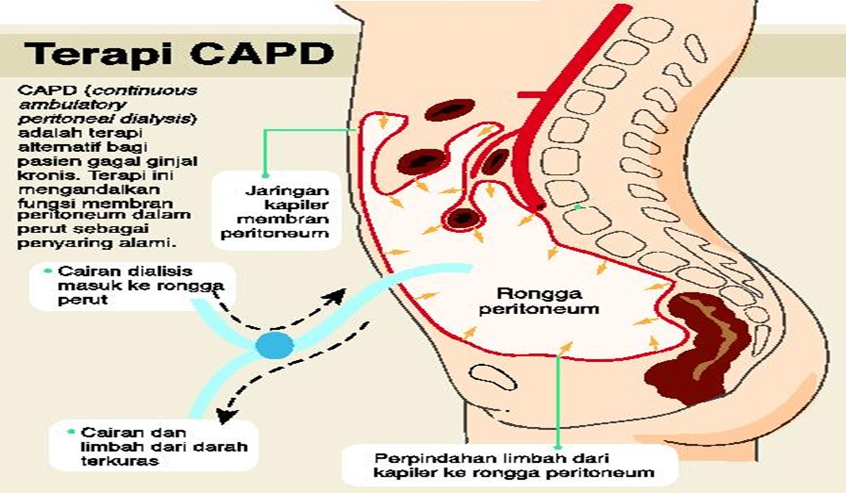 CAPD Therapy: A New Hope for Kidney Failure Patients Undergoing Dialysis