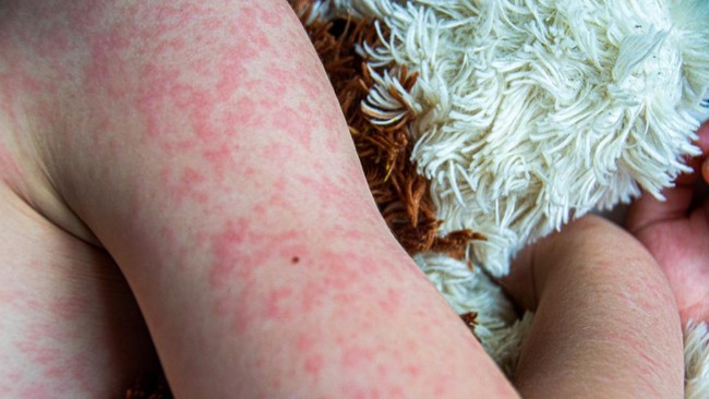 Ministry of Health Reveals Latest Situation of Measles Disease in Indonesia