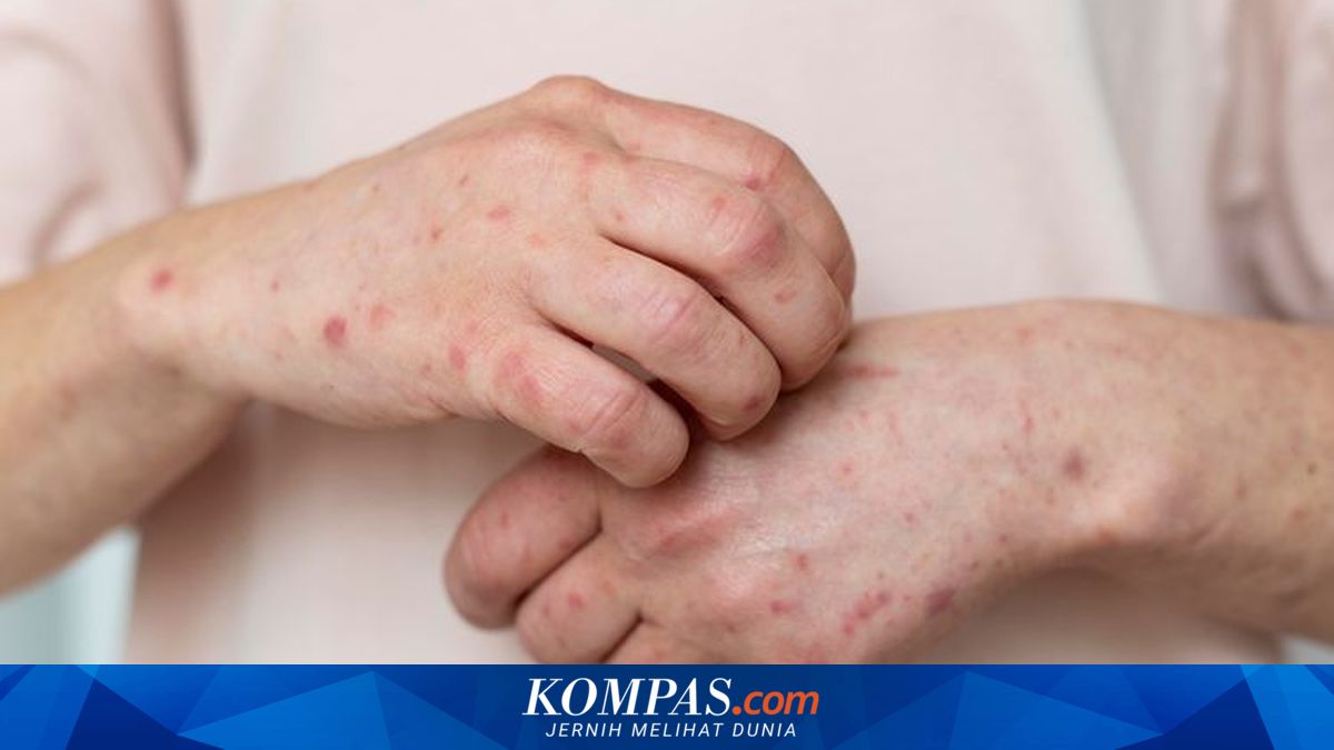 Ministry of Health Issues Alert on Measles After Death of Young Doctor from the Disease