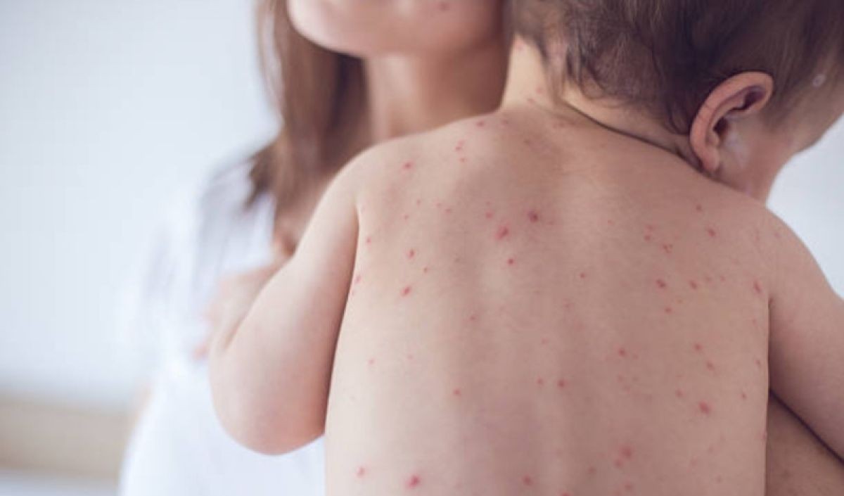 Ministry of Health: Risk Gap for Babies Contracting Measles Before Vaccination