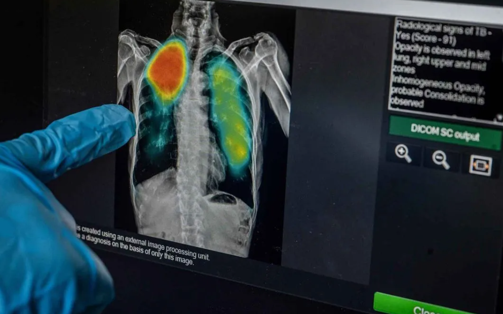 WHO Reveals Four Major Global Challenges in Combating Tuberculosis