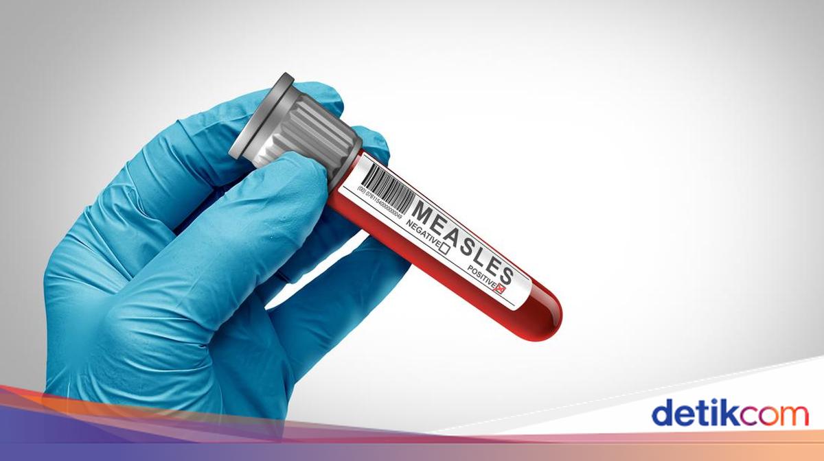 Banten Measles Case Data: 4,456 Suspects, 157 Positive, 6 Patients Deceased