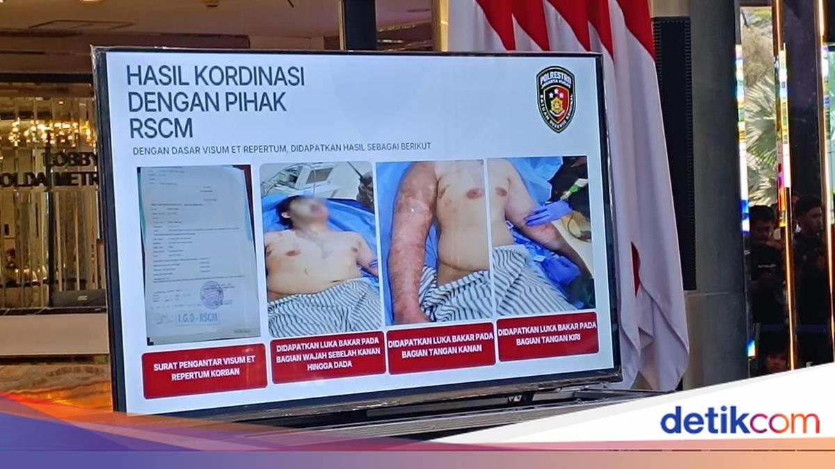 Andrie Yunus Suffers 20% Burns from Caustic Liquid, Cornea Damage at 40%