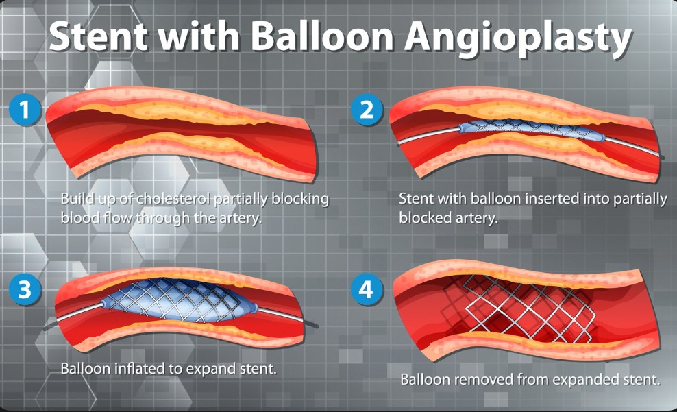Understanding Angioplasty: The Medical Procedure Undergone by Denmark's Queen Margrethe II