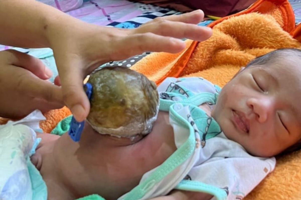 Infant with intestinal abnormality in Pandeglang seeks donor assistance