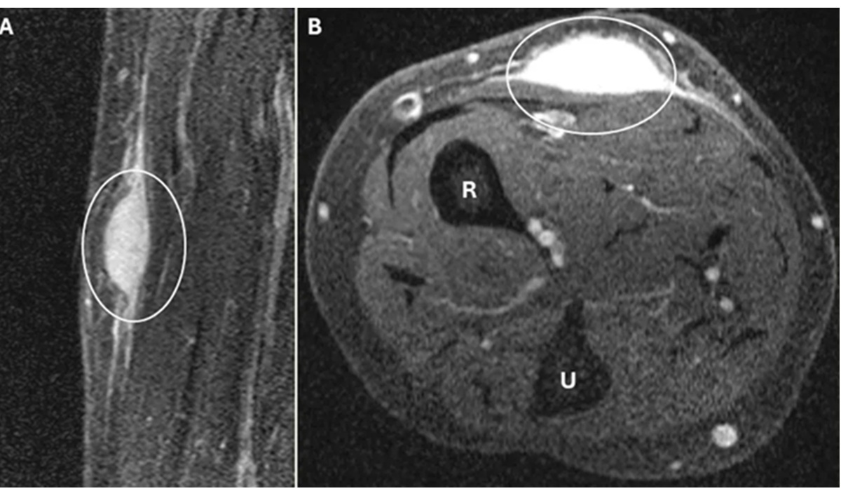 Cancer Disappears After Biopsy: Rare Medical Case in a 59-Year-Old Woman Astonishes Doctors