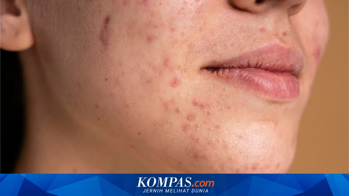 Why Can a Breakup Trigger Breakouts and Acne?