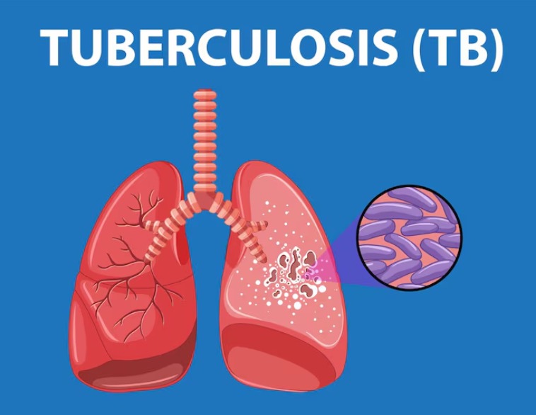 20 Deaths as Tuberculosis Cases in Garut Regency Reach 3,939