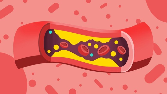 Researchers discover single-infusion treatment to slash cholesterol levels