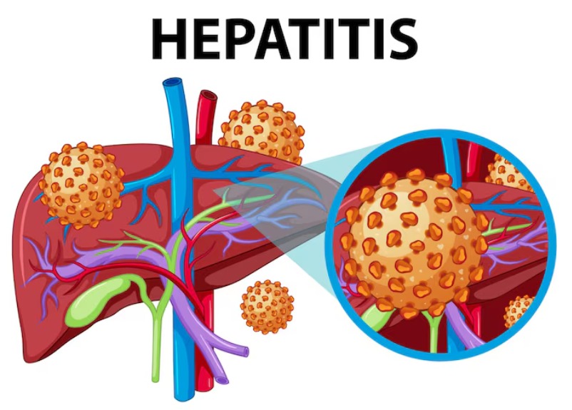 Understanding Hepatitis: Symptoms, Causes, and the Latest Prevention Methods for 2026
