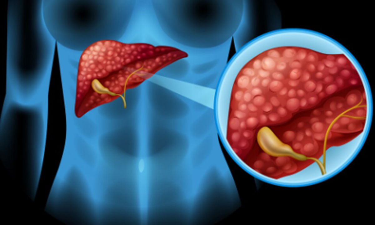 New Drug Daraxonrasib Doubles Survival Time for Pancreatic Cancer Patients