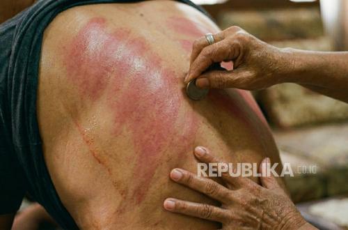 Doctor Warns Against 'Kerokan' for Chest Pain