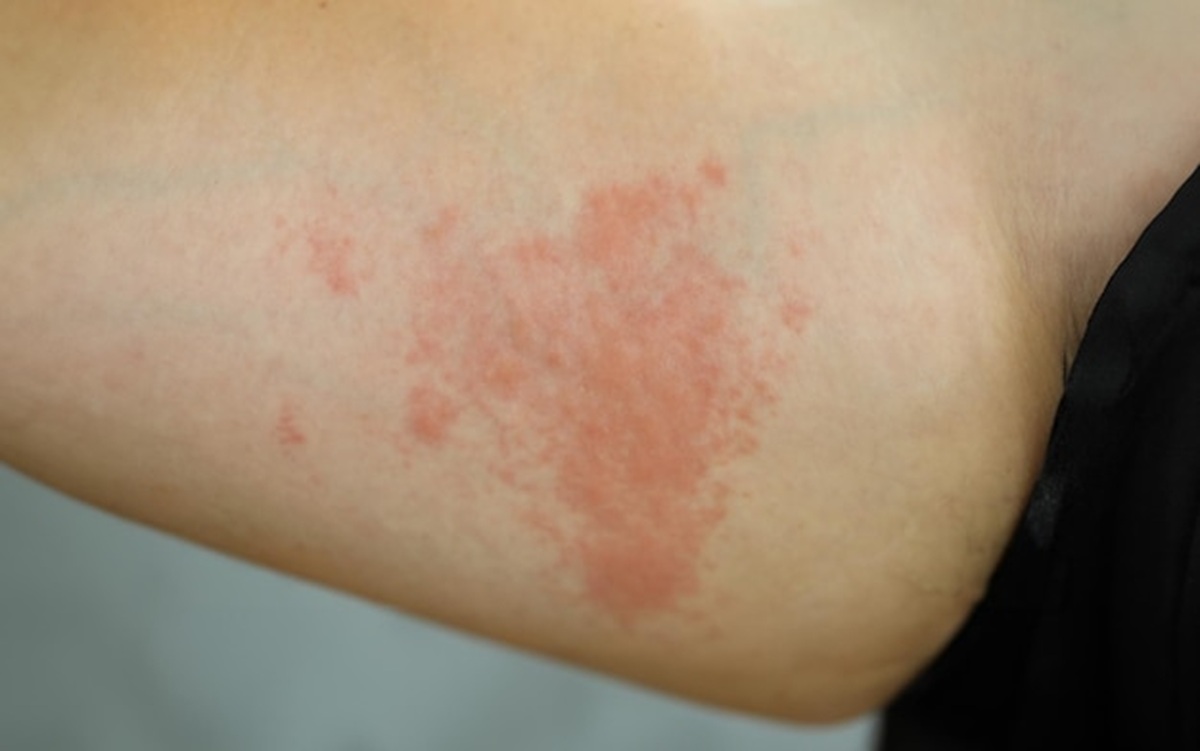 Measles Can Trigger Lung Infection and Brain Inflammation, Here's the Explanation