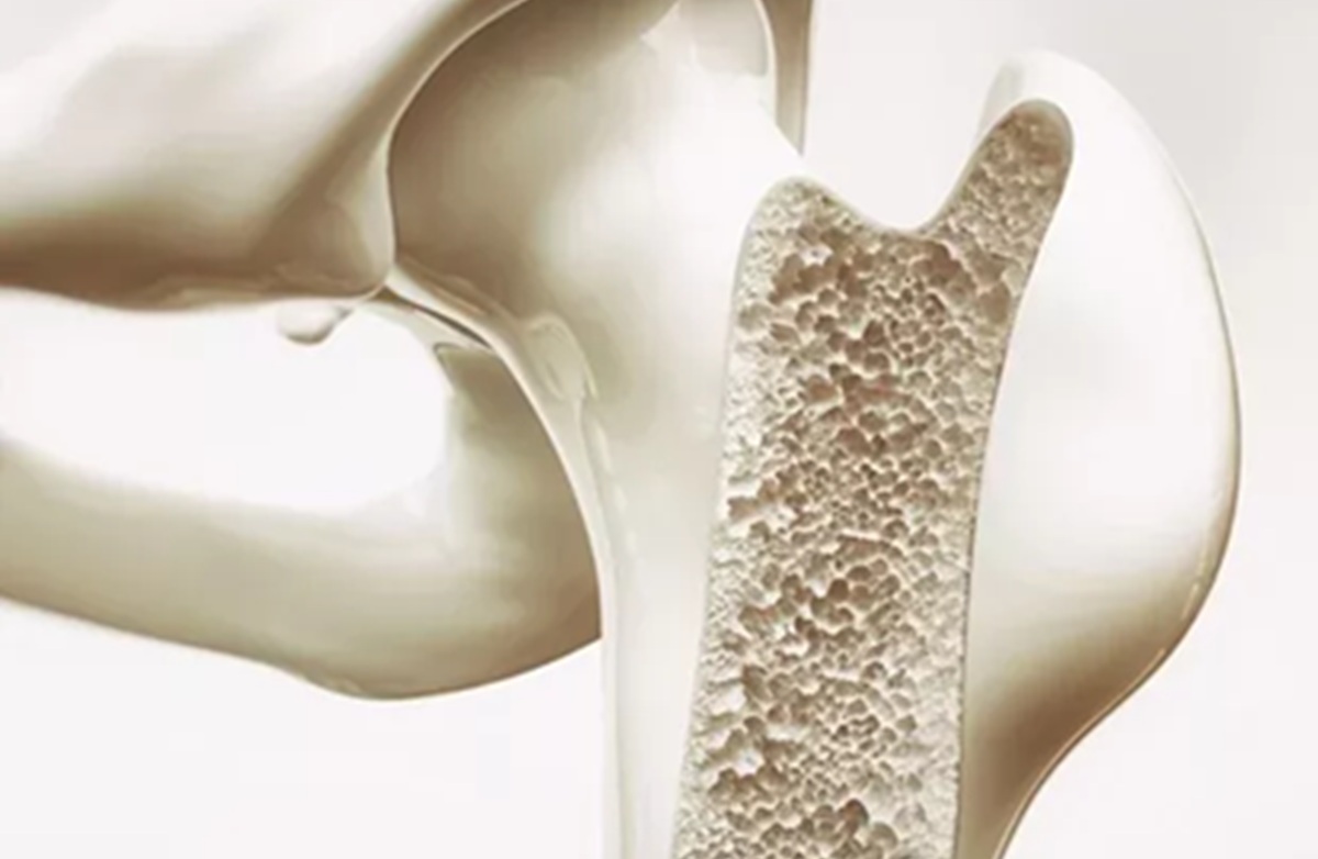 Calcium and Vitamin D Supplements Found Ineffective in Preventing Fractures in the Elderly