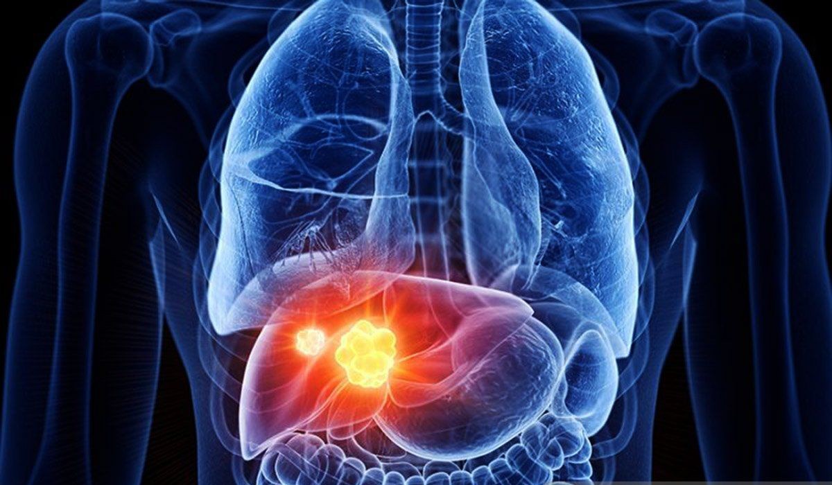 Fatty Liver Disease Increasingly Affects Young Adults, Lifestyle Changes Crucial