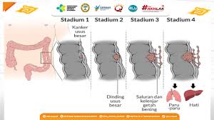Colon Cancer Symptoms Often Mistaken for Haemorrhoids, Experts Warn of Dangers