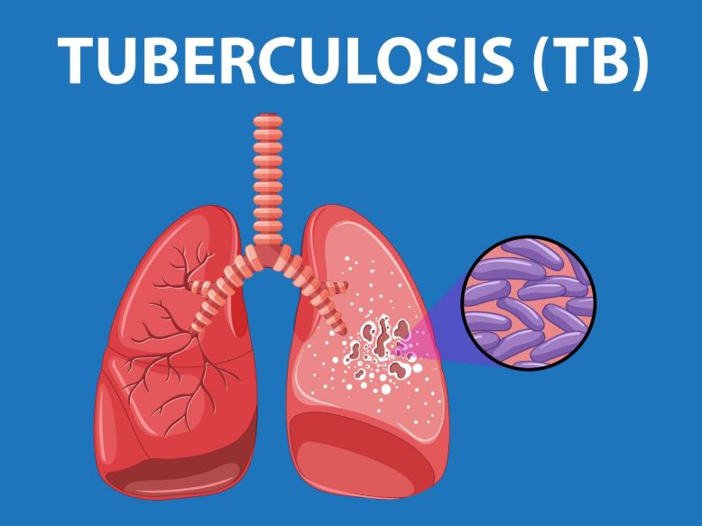 Beware of Early Tuberculosis Symptoms: Persistent Cough and Weight Loss