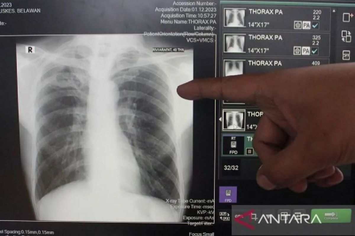 Lampung Pursues TB Elimination by 2030