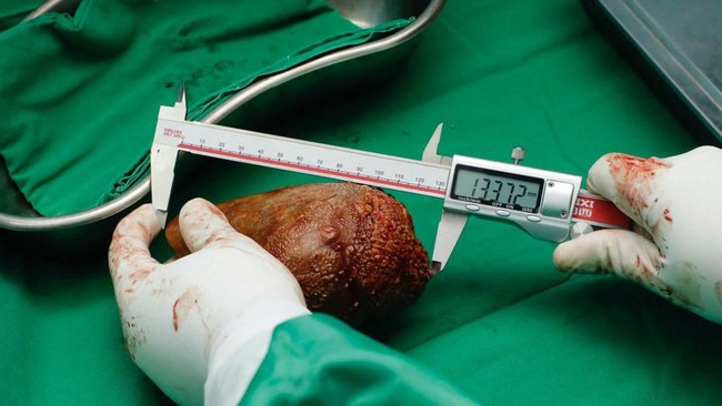4 Clear Signs of Kidney Damage Visible During Urination