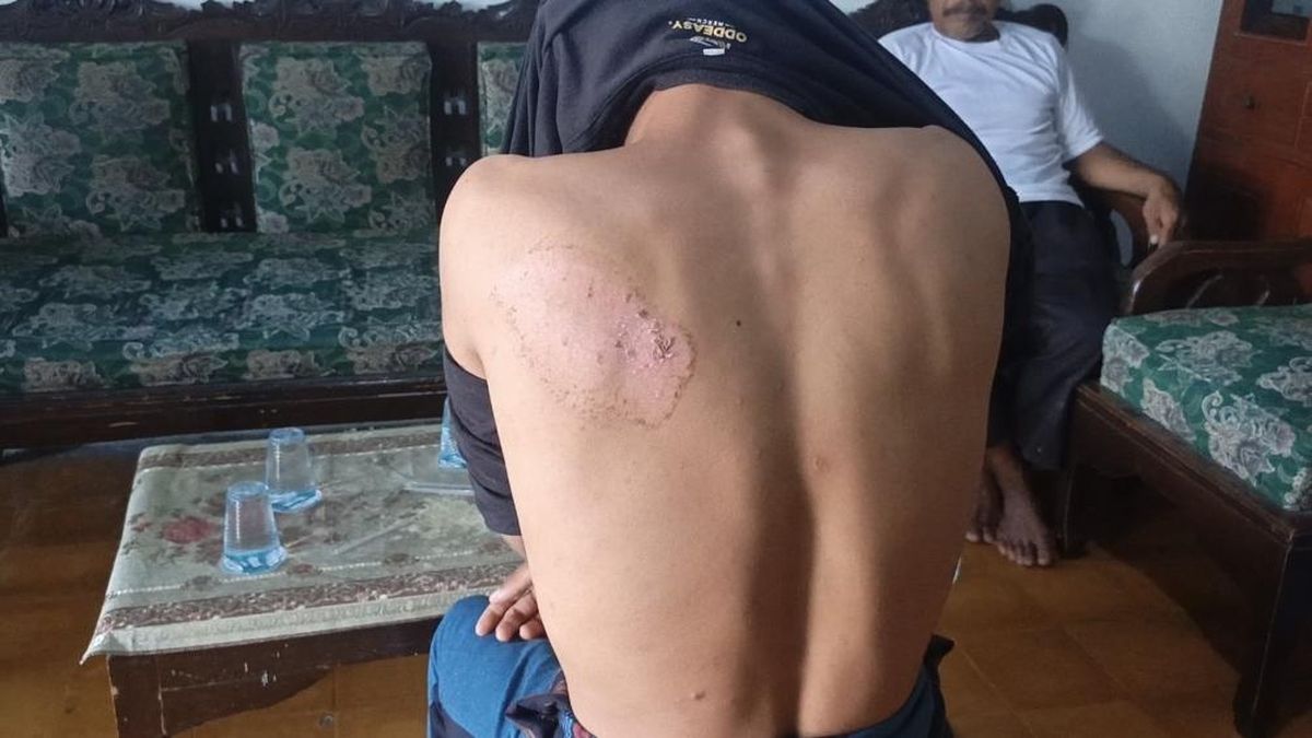 Disabled Student in Gresik Allegedly Burned with Iron by Junior